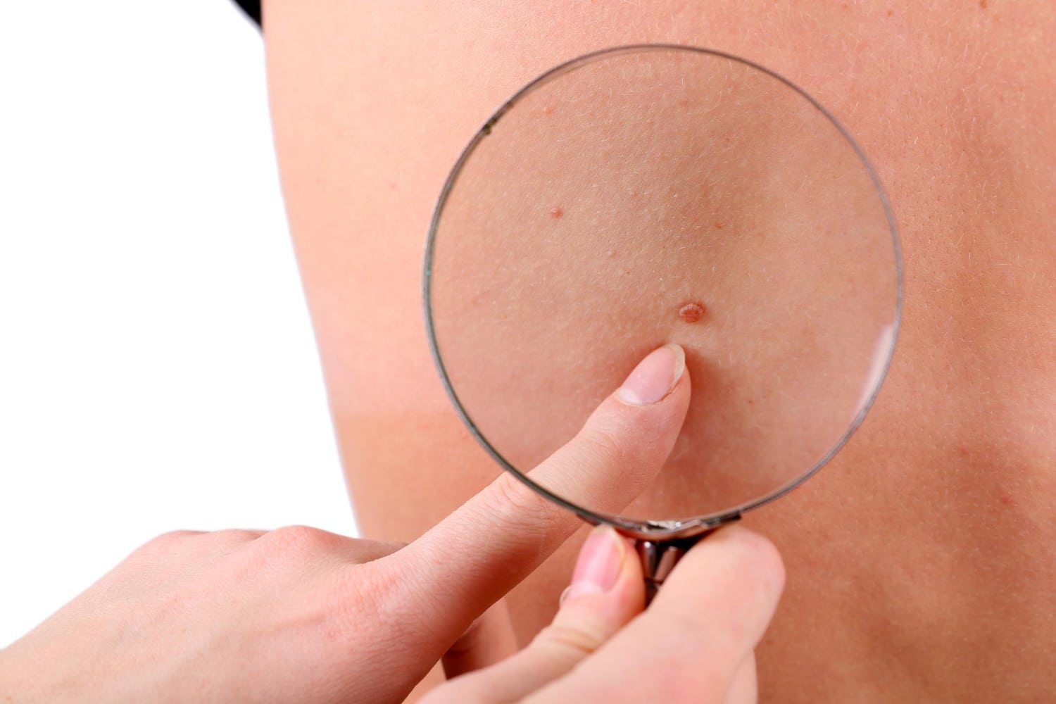 basal cell carcinoma מה זה