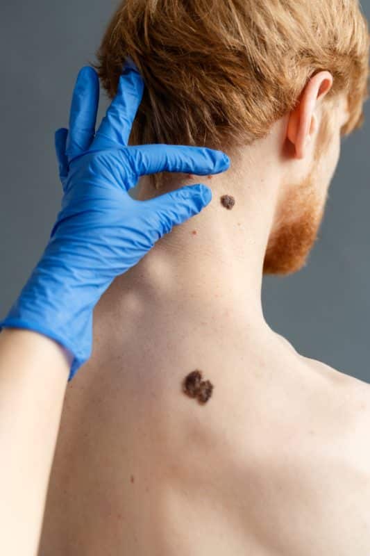 carcinoma in situ מה זה