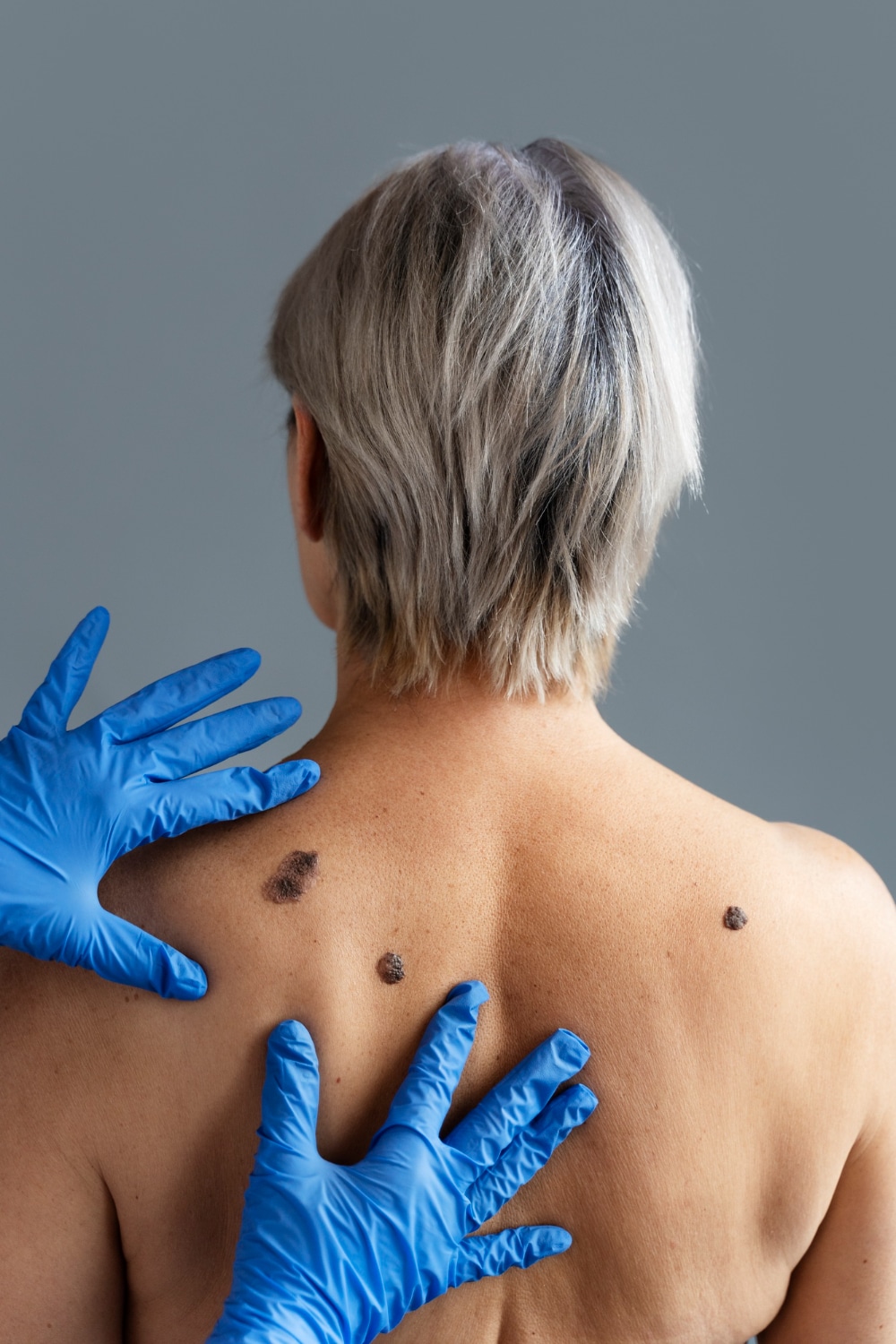 Melanoma BCC SCC