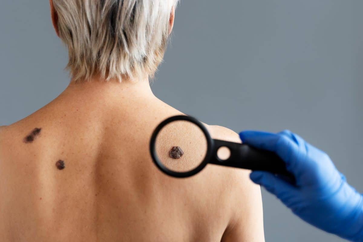 סרטן העור טיפול