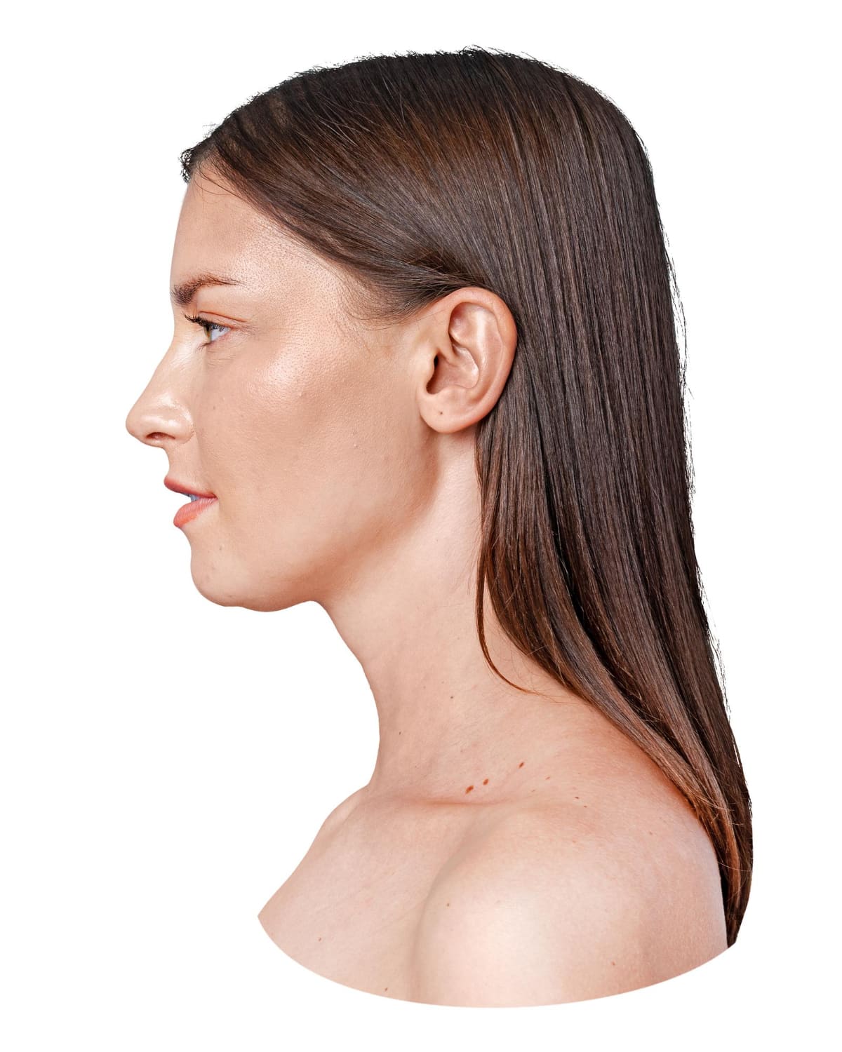 המסת שומן מהסנטר ללא ניתוח