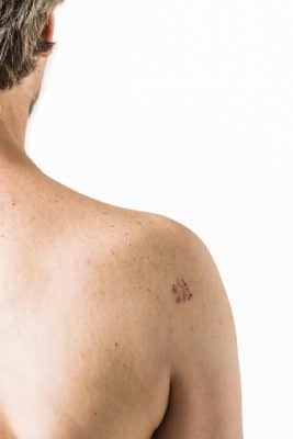 סרטן קרצינומה