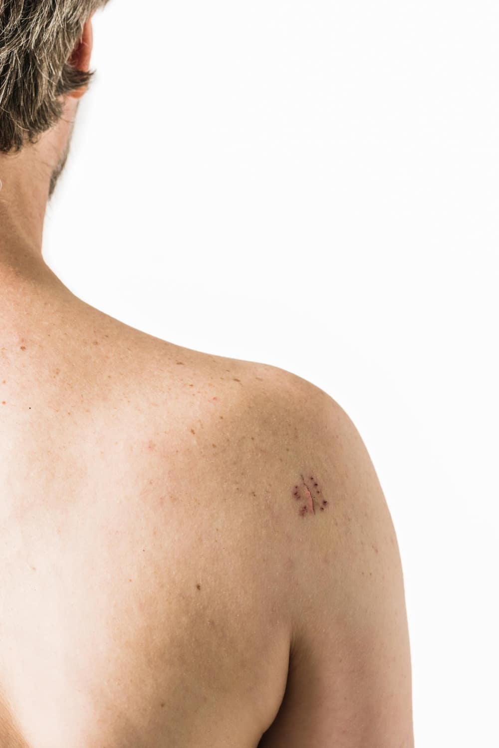 סרטן קרצינומה