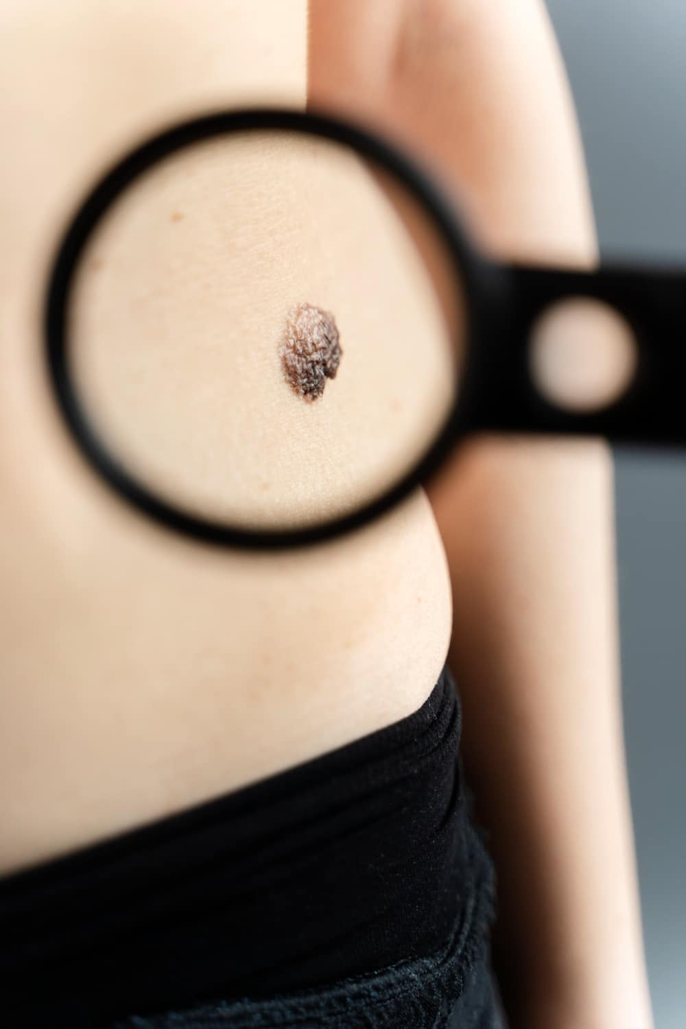 קרטואקנטומה בעור