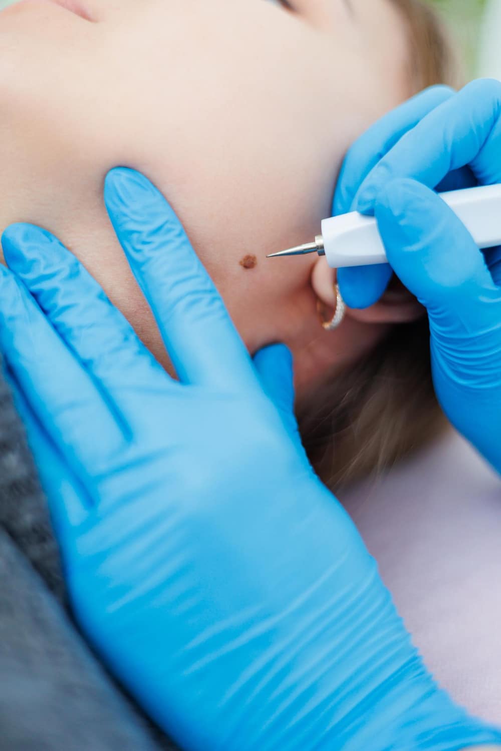 קרצינומה טיפול