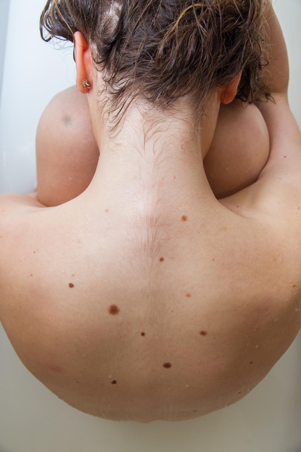 קרצינומה תסמינים