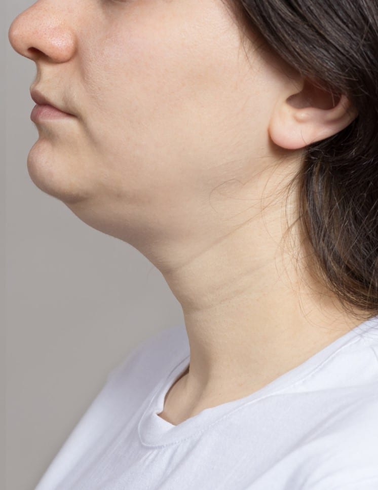 שאיבת שומן בסנטר כפול