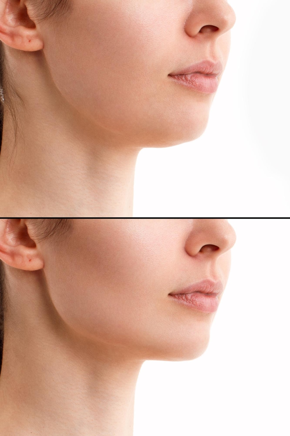 שאיבת שומן בסנטר