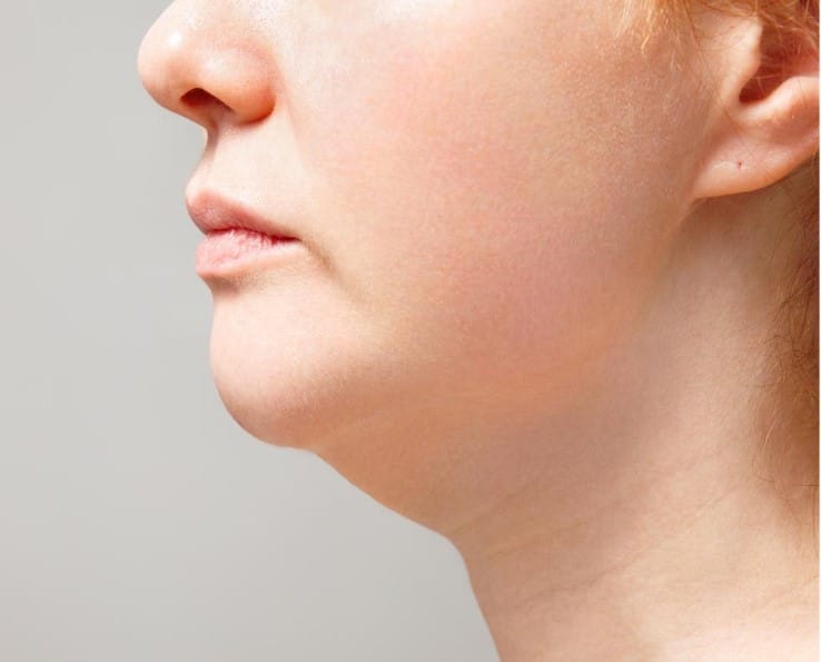 שאיבת שומן מהסנטר סיכונים