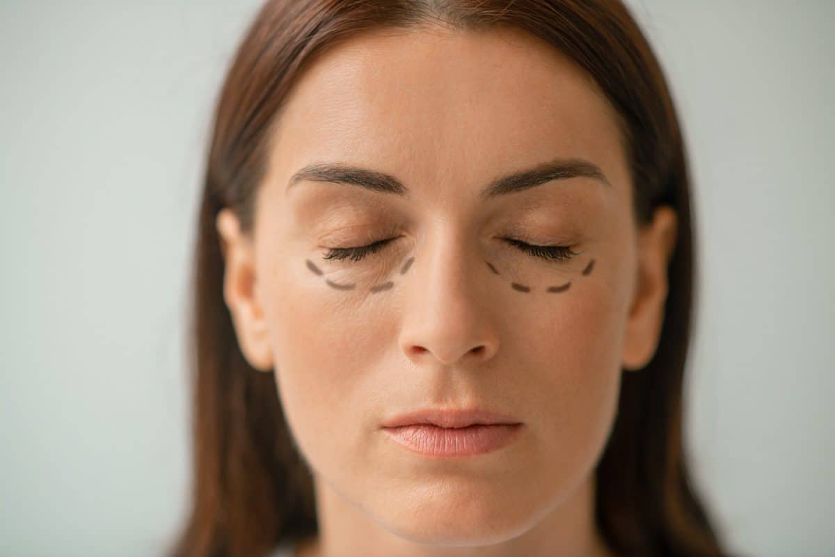 ניתוח עפעפיים עליונים ותחתונים