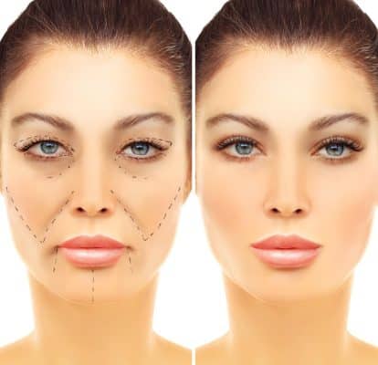 עפעפיים תחתונים