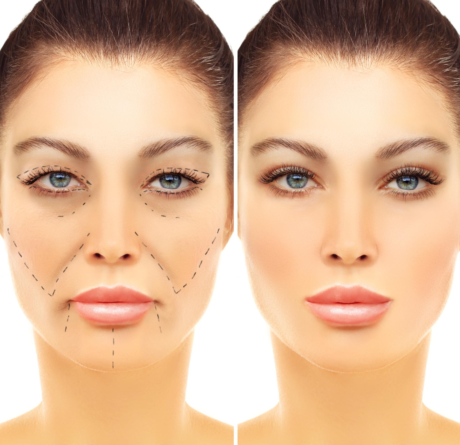 עפעפיים תחתונים