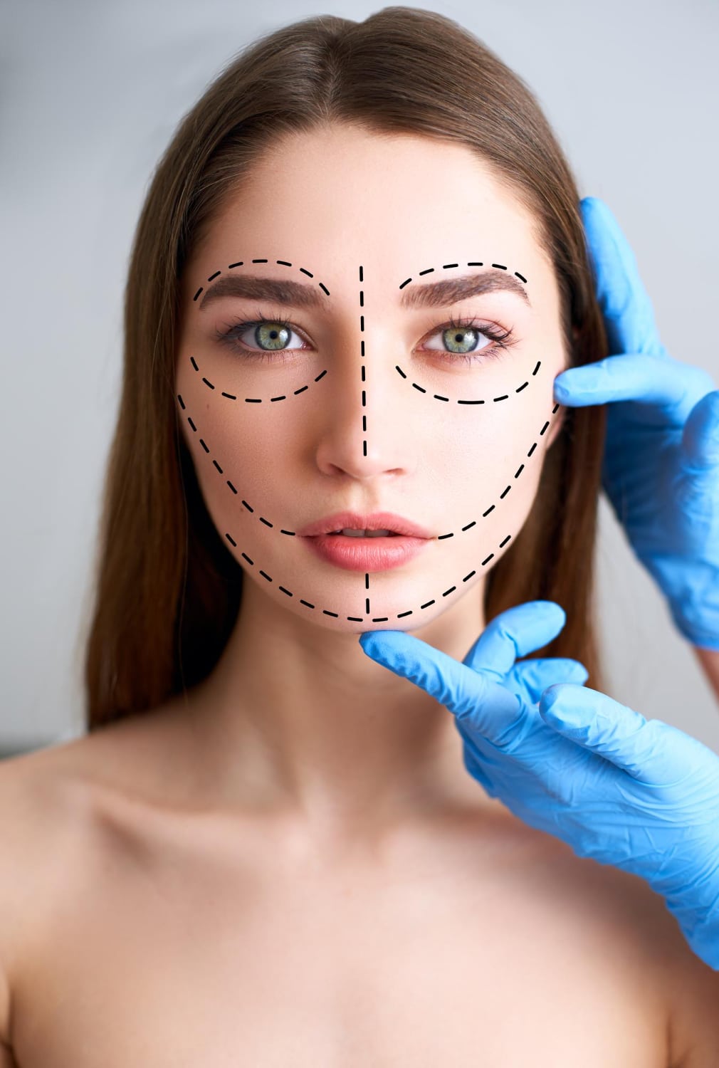 מתיחת פנים על ידי חוטים