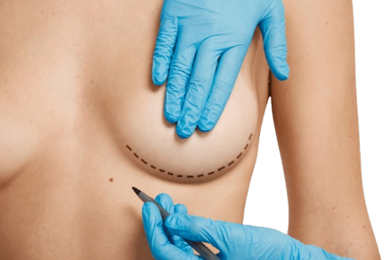 הגדלת שדיים עם שומן עצמי